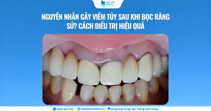 Nguyên nhân gây viêm tủy sau khi bọc răng sứ? Cách điều trị hiệu quả