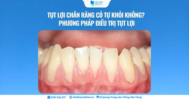 Tụt lợi chân răng có tự khỏi không? Phương pháp điều trị tụt lợi