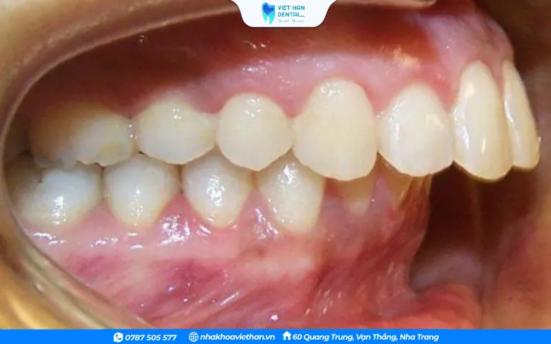 Sai lệch khớp cắn ảnh hưởng đến khả năng cắn và nghiền thức ăn