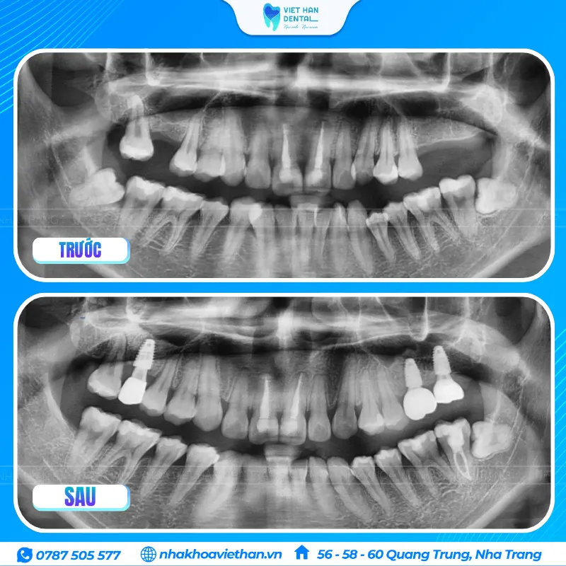 Trồng răng Implant khôi phục chức năng ăn nhai