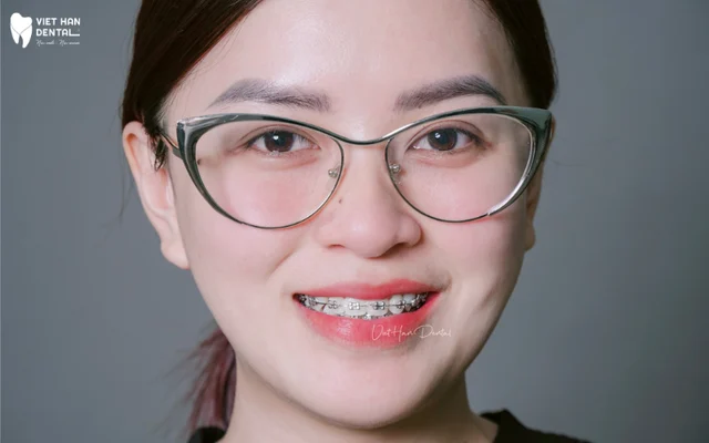 Khách hàng cso tình trạng răng hô đang điều trị tại Nha khoa Việt Hàn của Bác sĩ Bùi Thị Giang