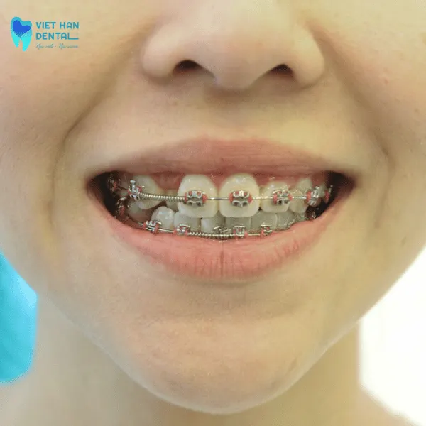 Niềng răng cho con khi gương mặt bị mất cân đối