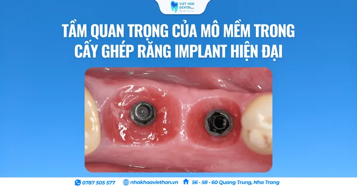 Tầm quan trọng của mô mềm trong cấy ghép răng Implant hiện đại