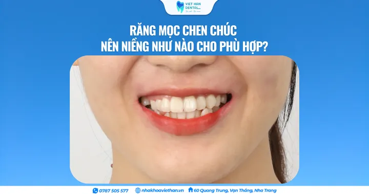 Răng mọc chen chúc nên niềng như nào cho phù hợp?