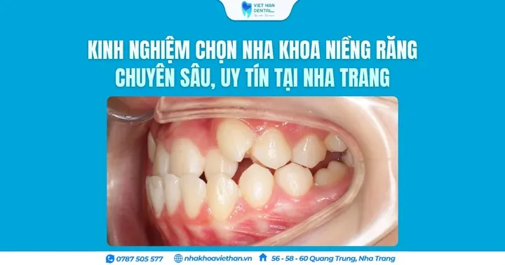Kinh nghiệm chọn nha khoa niềng răng chuyên sâu, uy tín tại Nha Trang