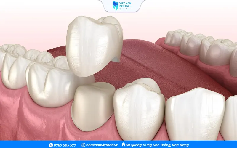 Bọc răng sứ toàn sứ