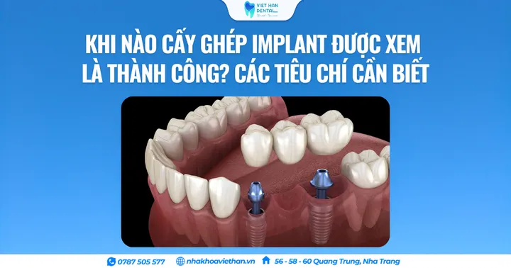 Khi nào cấy ghép Implant được xem là thành công? Các tiêu chí cần biết