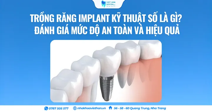 Trồng răng Implant kỹ thuật số là gì? Đánh giá mức độ an toàn và hiệu quả