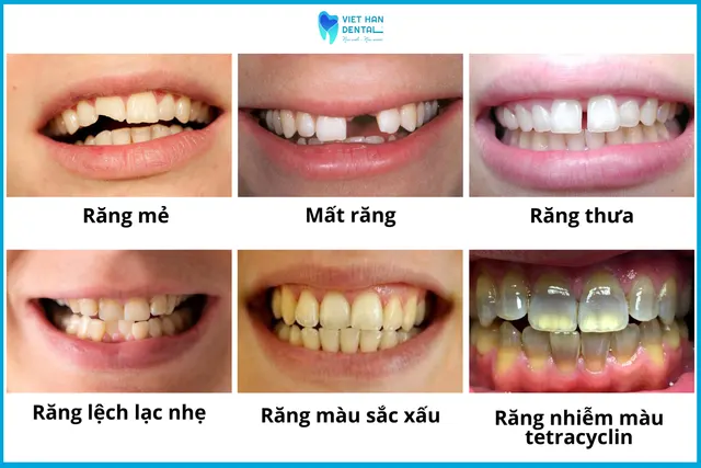Trường hợp có thể thực hiện răng sứ thẩm mỹ