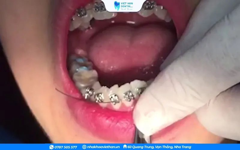 Răng dịch chuyển dẫn đến thừa dây cung là nguyên nhân khiến dây cung đâm vào miệng
