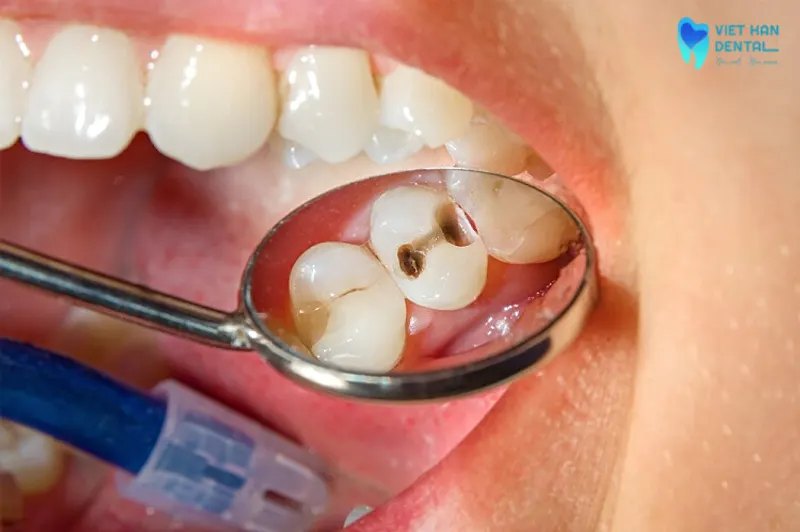 Một ca hàn&nbsp;trám răng tốt sẽ không tổn hại tới mô răng, mô mềm