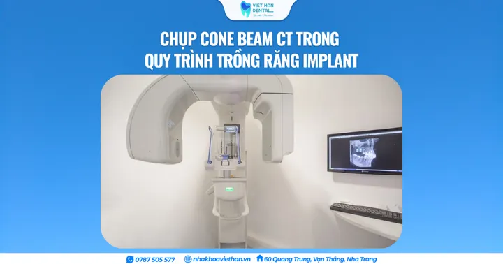 Chụp Cone Beam CT trong quy trình trồng răng Implant