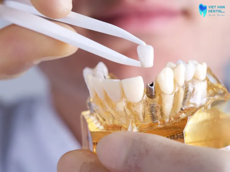 trong-rang-implant-gia-bao-nhieu-tai-Nha-Trang