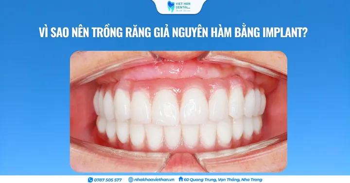 Vì sao nên trồng răng giả nguyên hàm bằng Implant?