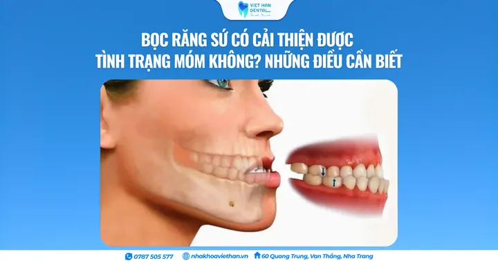 Bọc răng sứ có cải thiện được tình trạng móm không? Những điều cần biết