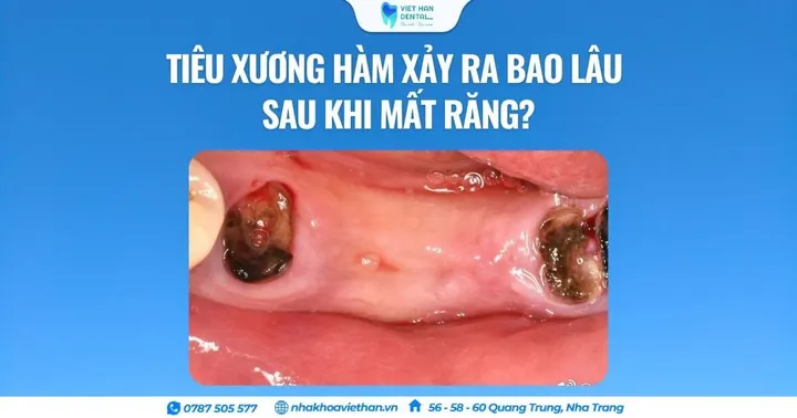Tiêu xương hàm xảy ra bao lâu sau khi mất răng?