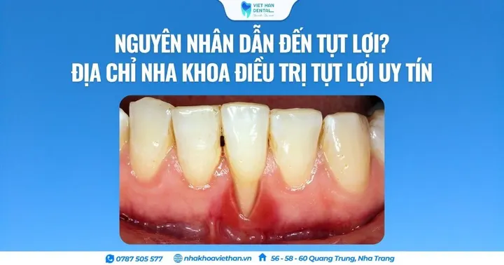 Nguyên nhân dẫn đến tụt lợi? Địa chỉ nha khoa điều trị tụt lợi uy tín