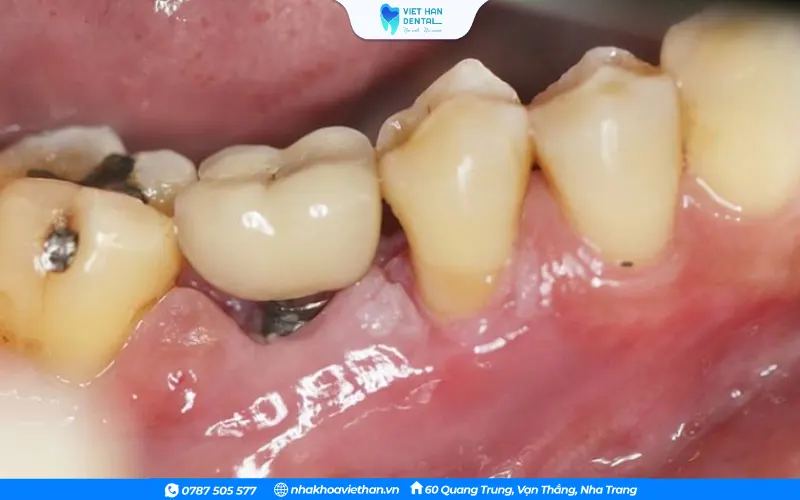 Bắt buộc bác sĩ phải loại bỏ implant bị đào thải dẫn đến tình trạng bị lung lay ra khỏi cung hàm 