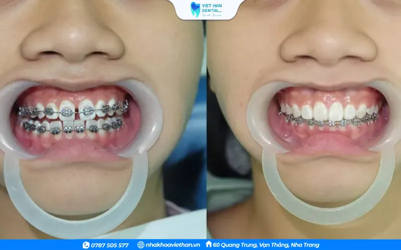 Niềng răng toàn hàm để tối ưu kết quả niềng răng