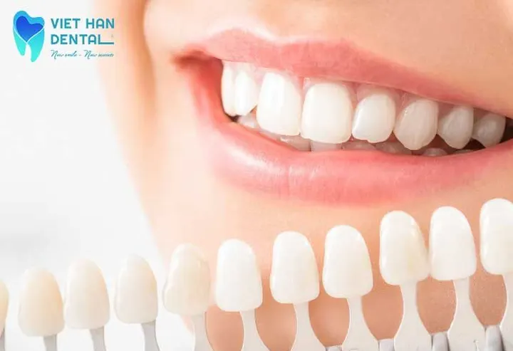 Địa chỉ dán sứ Veneer uy tín tại Nha Trang