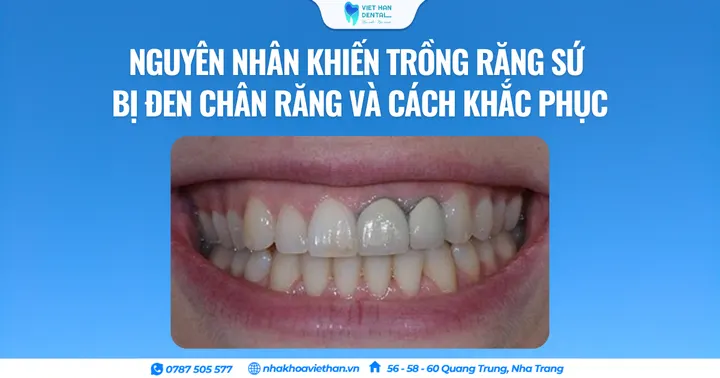 Nguyên nhân khiến trồng răng sứ bị đen chân răng và cách khắc phục