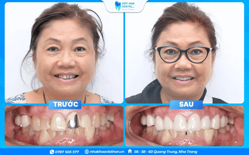 Cô Kim Ngọc hài lòng với kết quả sau khi điều trị tại Nha khoa Việt Hàn