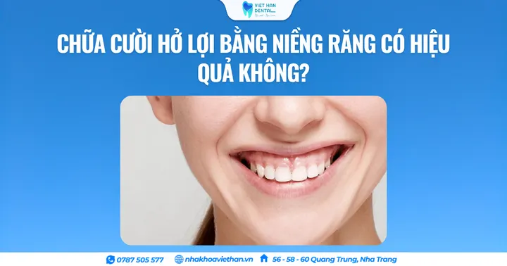 Chữa cười hở lợi bằng niềng răng có hiệu quả không?