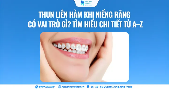 Thun liên hàm khi niềng răng có vai trò gì? Tìm hiểu chi tiết từ A–Z