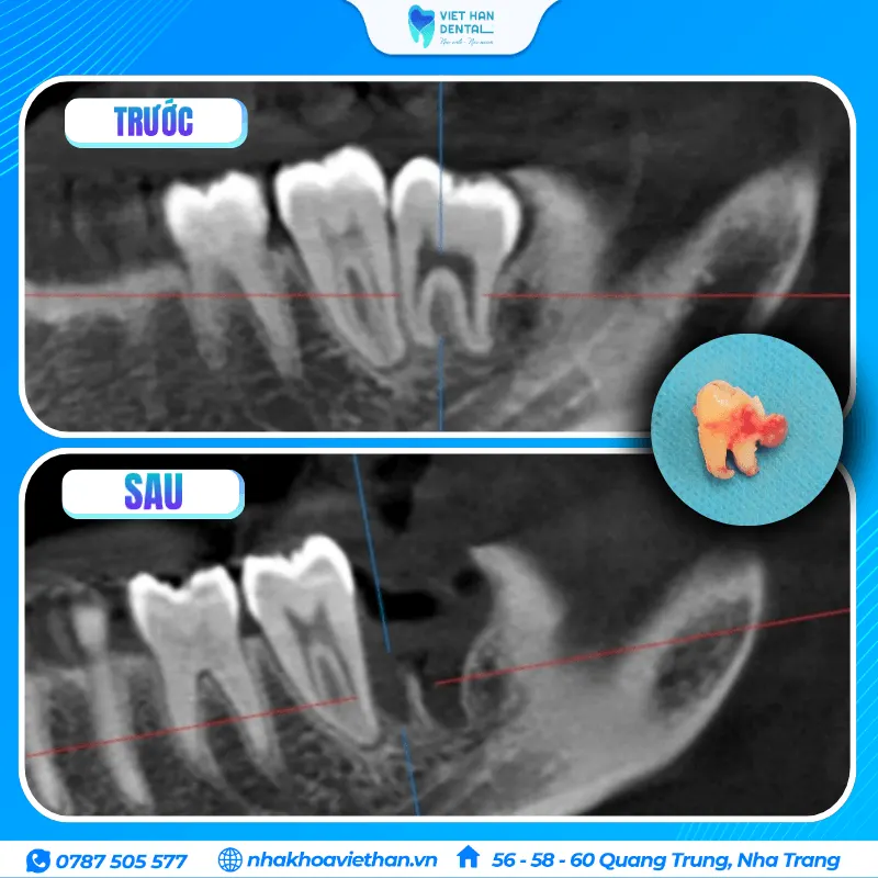 Khách hàng Quốc tế nhổ răng khôn tại Nha khoa Việt Hàn