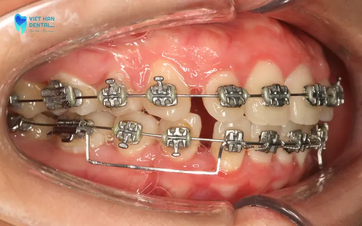 Bracket Braces