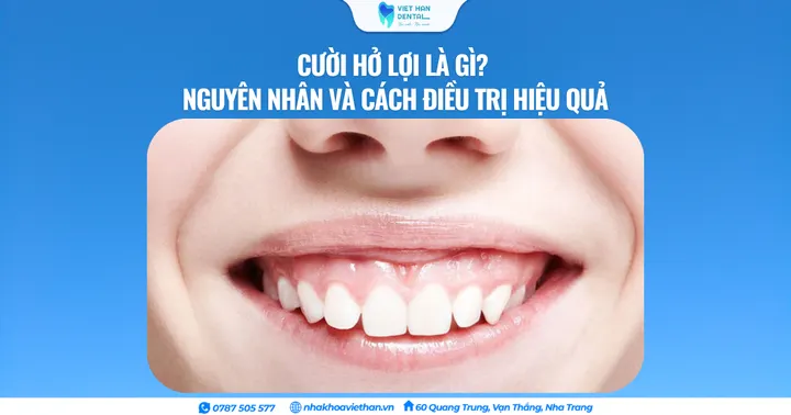 Cười hở lợi là gì? Nguyên nhân và cách điều trị hiệu quả