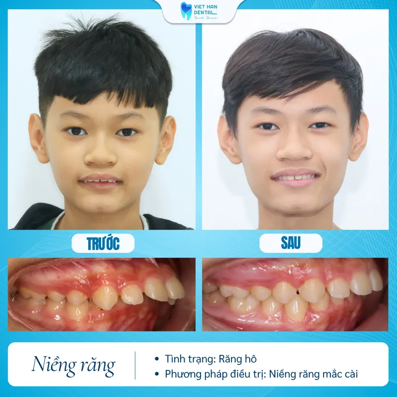 Khách hàng trước và sau khi chỉnh nha tăng trưởng tại Nha khoa Việt Hàn 