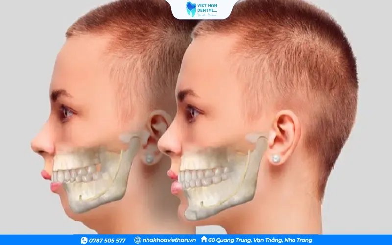 Mất cân đối giữa chiều dài xương hai hàm khiến cung răng không khớp đều