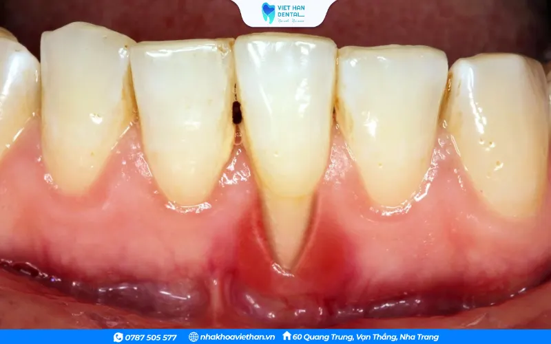 Tụt lợi dẫn đến mất răng