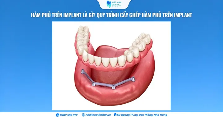 Hàm phủ trên Implant là gì? Quy trình cấy ghép hàm phủ trên Implant