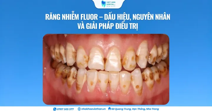 Răng nhiễm Fluor – Dấu hiệu, nguyên nhân và giải pháp điều trị