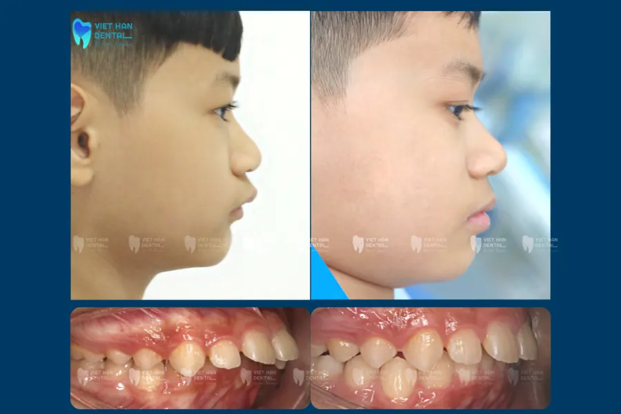 Niềng răng tăng trưởng giúp cải thiện khớp cắn