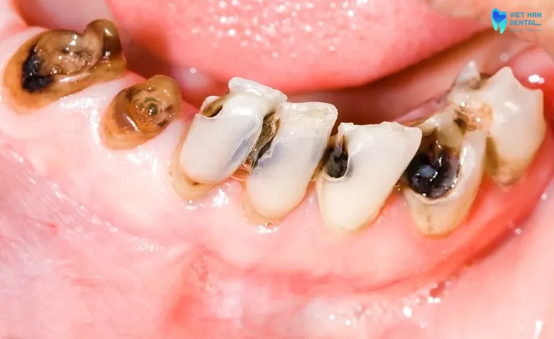 Vi khuẩn gây sâu răng ăn mòn men răng