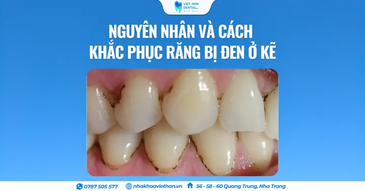 Răng bị đen ở kẽ: Nguyên nhân và cách khắc phục hiệu quả