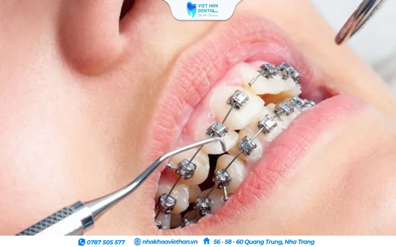 Chỉnh nha từ sớm khi xương hàm chưa cứng chắc giúp khớp cắn hai hàm trở về vị trí chuẩn sinh lý