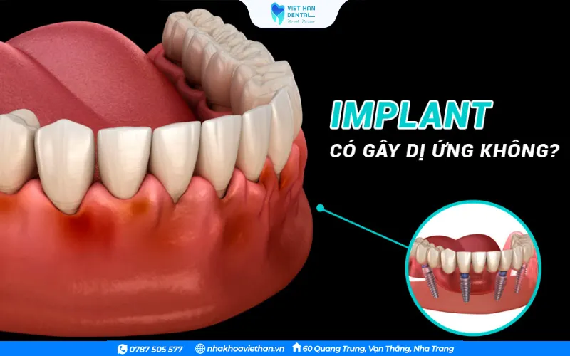 Trồng răng Implant có gây dị ứng không?