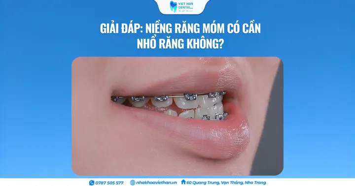 Giải đáp: Niềng răng móm có cần nhổ răng không?
