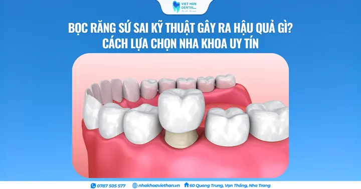 Bọc răng sứ sai kỹ thuật gây ra hậu quả gì? Cách lựa chọn nha khoa uy tín
