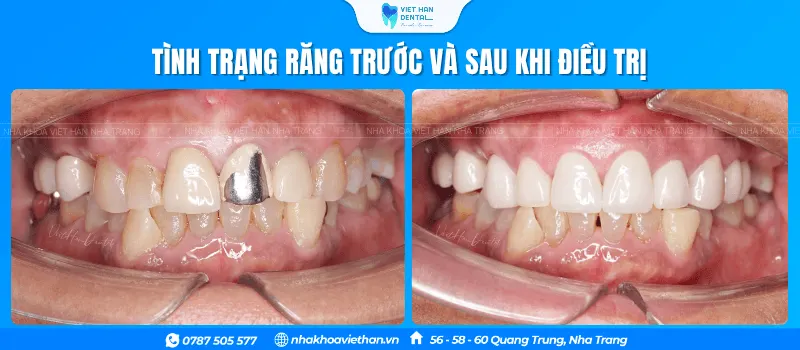 Tình trạng răng của cô Lâm Kim Ngọc trước và sau khi điều trị tại Nha khoa Việt Hàn