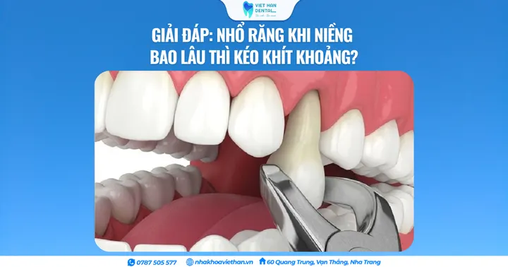 Giải đáp: Nhổ răng khi niềng bao lâu thì kéo khít khoảng?