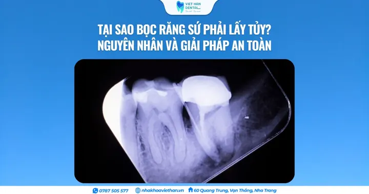 Tại sao bọc răng sứ phải lấy tủy? Nguyên nhân và giải pháp an toàn