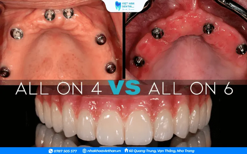 Phương pháp trồng răng All- on 4 và All - on - 6 khác nhau ở số lượng trụ
