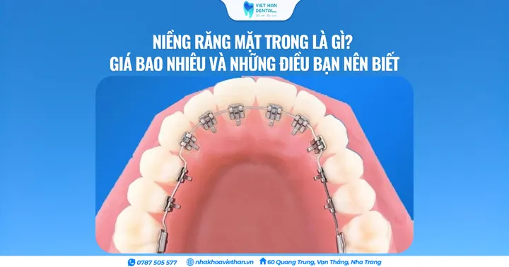 Niềng răng mặt trong là gì? Những điều bạn nên biết