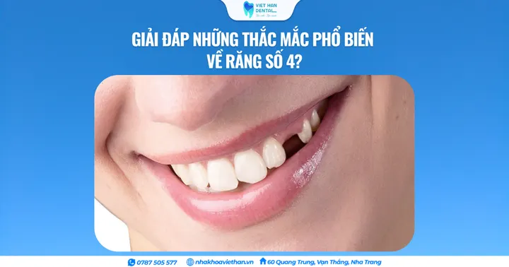 Giải đáp những thắc mắc phổ biến về răng số 4?
