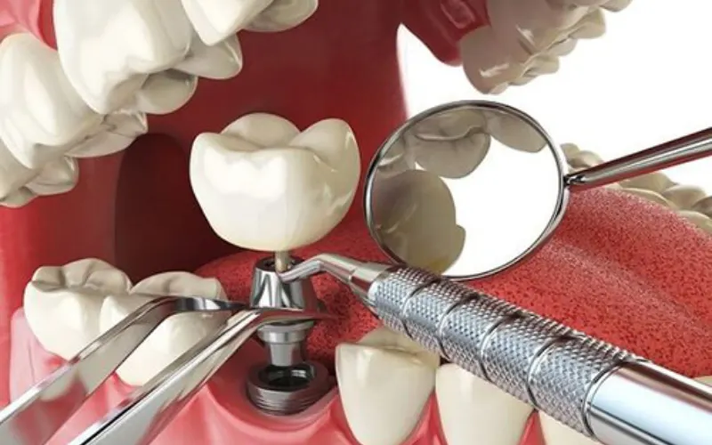 Trồng răng implant được nhiều chuyên gia nha khoa khuyên dùng